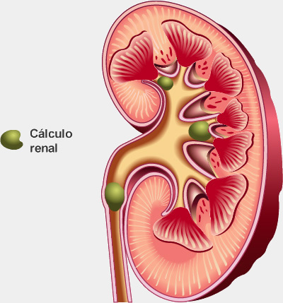 Cálculos renales (piedras) en el riñón